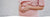 Listeria and pregnancy